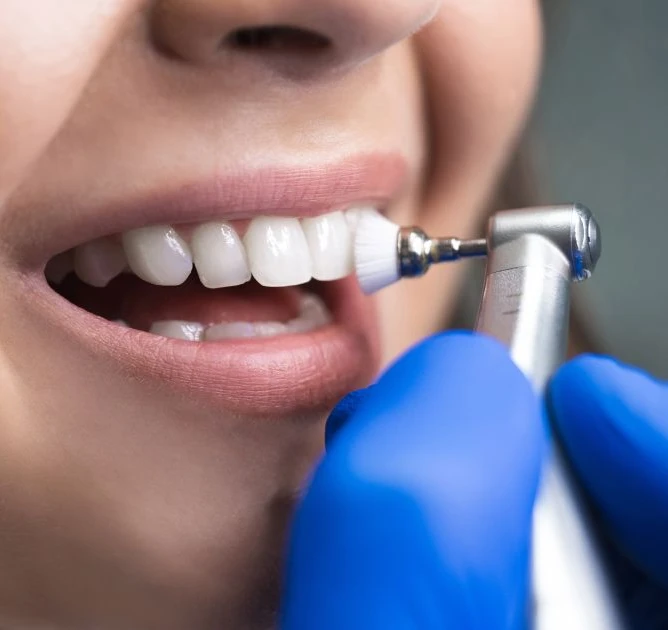 Dentist polishing patient's teeth with cleaning tool during professional dental cleaning.